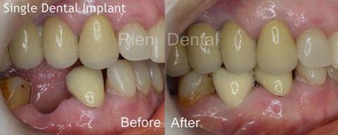 Rien Dental - Dentists Australia 6